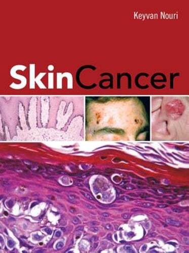 Skin Cancer by Keyvan Nouri: Used
