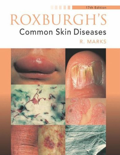 Roxburgh’s Common Skin Diseases, 17Ed (Medicine) By Ronald Marks